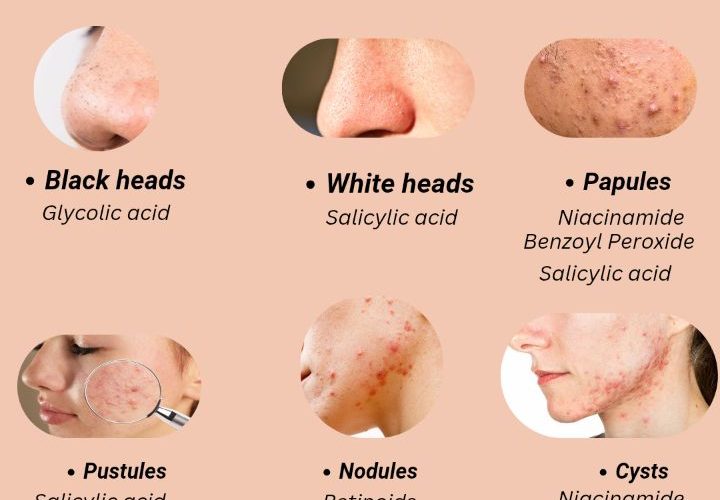 Panduan Lengkap Acnes Spot Care: Cara Kerja, Kandungan, dan Tips Menghilangkan Jerawat Membandel