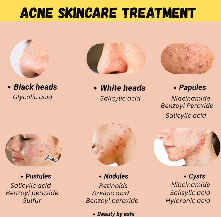 Panduan Lengkap Acnes Spot Care: Cara Kerja, Kandungan, dan Tips Menghilangkan Jerawat Membandel